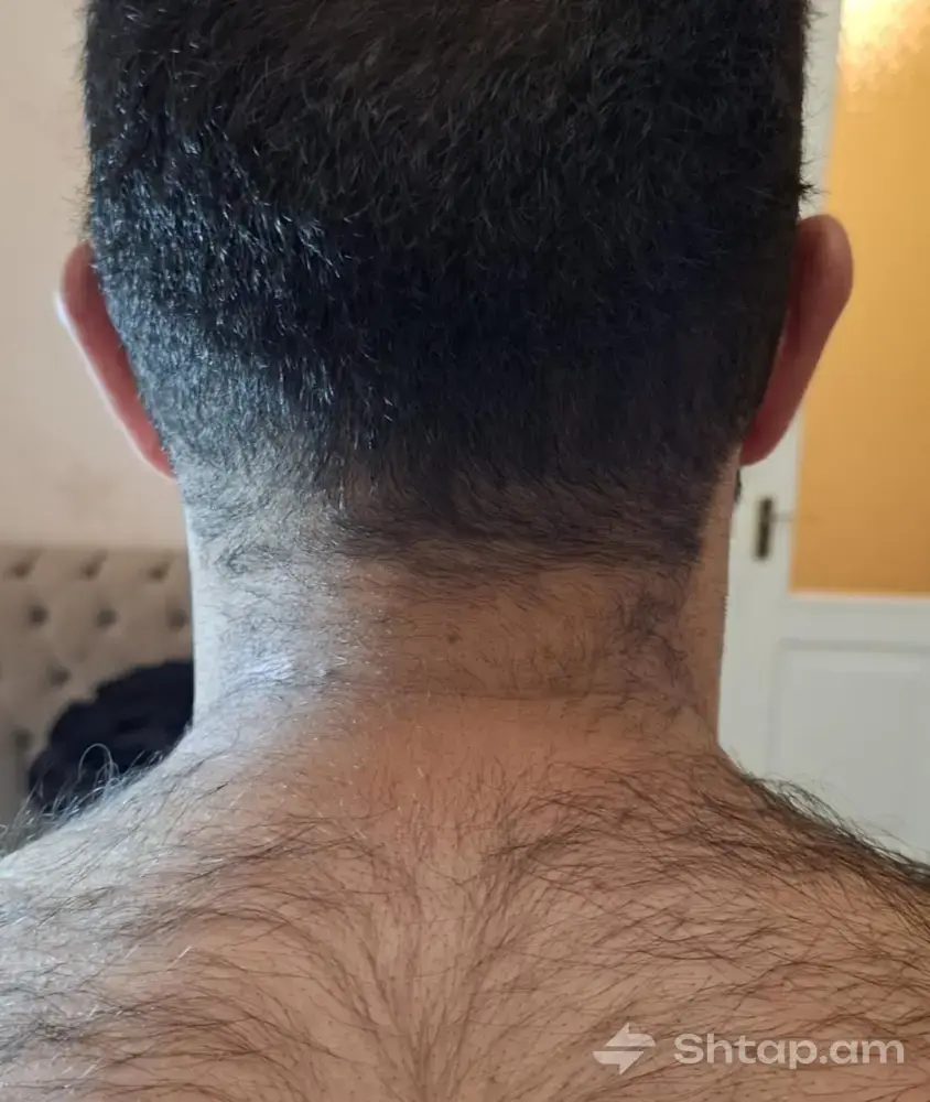 ELOS Hair Removal at a Special Price 0