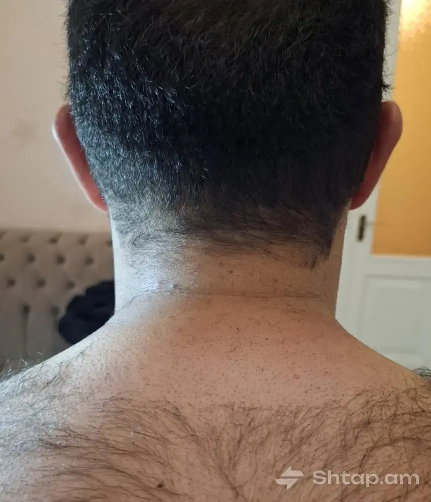ELOS Hair Removal at a Special Price 1